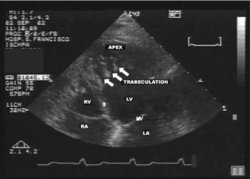 Figure 2. Four-chamber image of the same patient as in Figure 1, showing prominent  apical left ventricular trabeculation (white arrow), for whom a diagnosis of noncompaction  was suggested