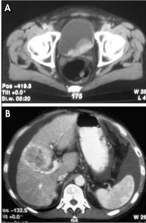 Figure 2. A) Computer tomography show- show-ing intravesical mass. B) Nodule  measur-ing 7.5 cm in diameter in a cirrhotic liver  suggesting metastasis.