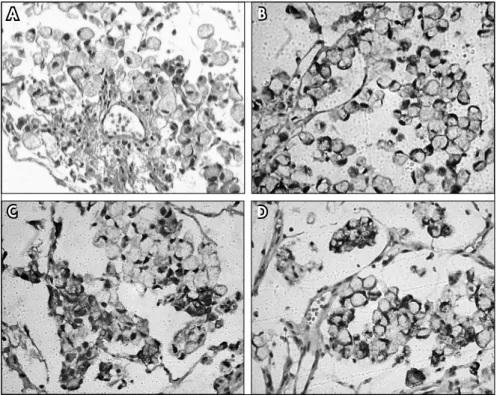 Figure 3. A) Mucinous adenocarcinoma of the bladder with signet-ring cells (hematoxy- (hematoxy-lin-eosin, 200 x)