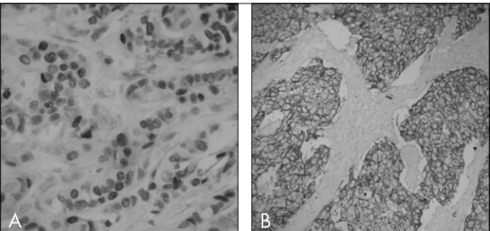 Table 2. Results from immunohistochemical staining on tissue microarray of breast  cancer tumors