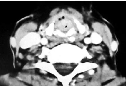 Figure 4. Axial computed tomography scan. Tumor (*) affecting the larynx at the  glottis level