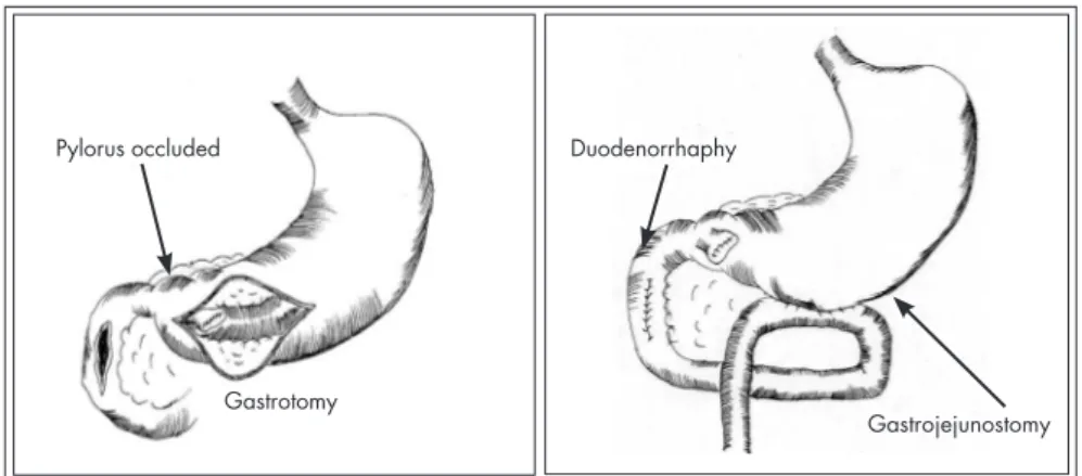 Figure 2. (A) Computed tomography showing air in retroperitoneum; (B) grade IV duodenal injury in third portion; (C) duodenal  repair; (D) pylorus closed; (E) gastrojejunostomy; (F) feeding jejunostomy.