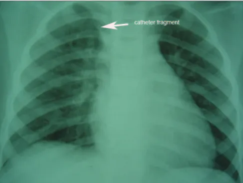 Figure  2.  Interventional  endovascular  procedure to retrieve catheter fragment.
