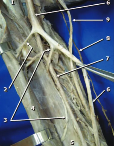 Figure 3. Anterior view of the right cubital  fossa. The branch of the median nerve to  the  brachialis  muscle  (1)  goes  in  deeply  to  the  biceps  brachii  muscle  and  then  continues as the lateral antebrachial  cuta-neous nerve (4)