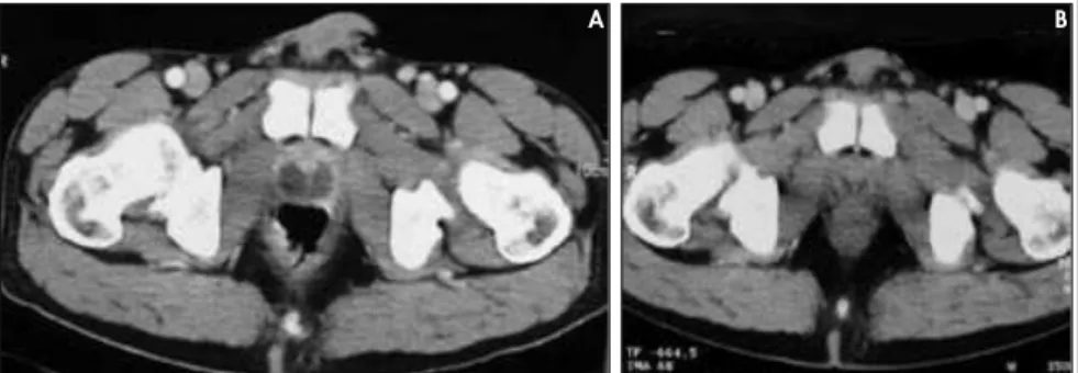 Figure 1. A. Computed tomography examination showing a large prostatic abscess  with necrosis