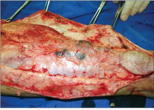 Figure 2. Popliteal lymphadenectomy.