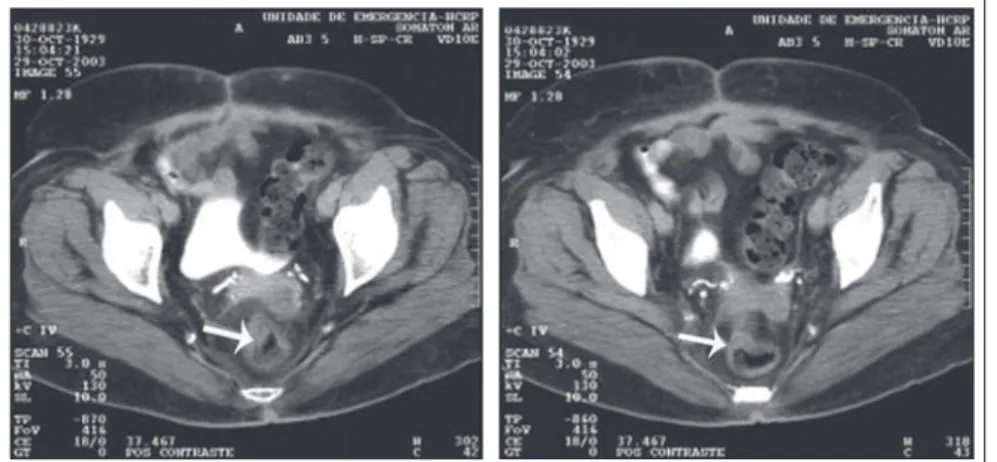 Figure 2. Preoperative colonoscopy, showing friable and stenosing tumor formation  in the upper rectum.
