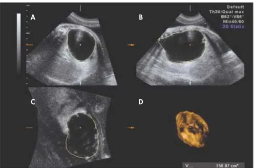 Figure 2. 3D estimated volume of the adenomatoid cyst at 33 weeks: A) transverse  section; B) sagittal section; C) coronal section; and D) rendered image.