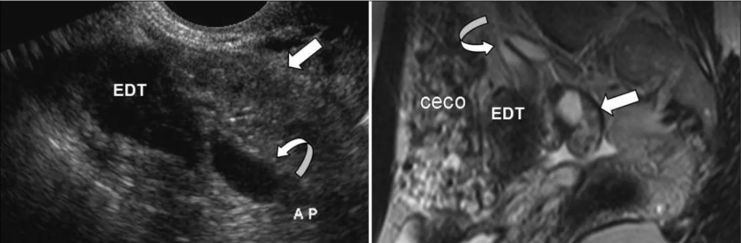 Figure 2. Intraoperative image of lesion  at the ileocecal junction compatible with  endometriosis.