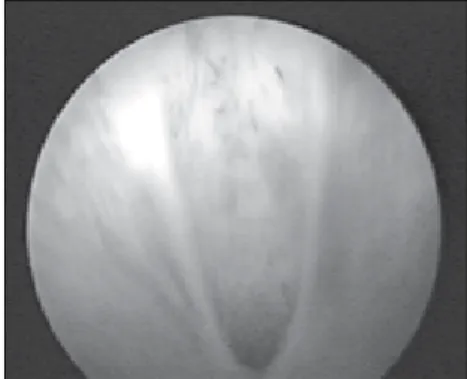Figure 1.1. Voiding cystourethrography  showing dilation and wide urethra in an  11-year-old boy.