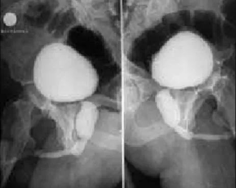Figure 2. Voiding cystourethrography  showing dilation and wide urethra, and  several urethral stenoses, in a 40-year-old  adult who had had a history of weak  urine stream since childhood.