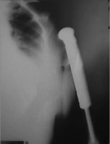 Figure 4. Radiograph showing wide resection of the proximal humerus with  endoprosthesis replacement