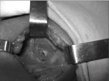Figure 2. Typical parathyroid tissue seen in the cyst wound. Hematoxylin  and eosin, 400 X.