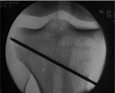 Figure 1. Kirschner wire acting as a guide for the osteotomy cut.