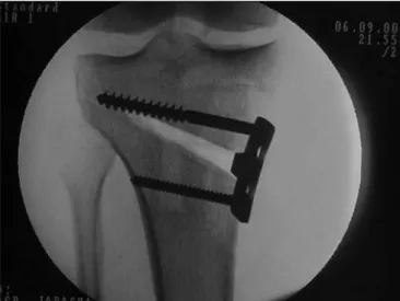 Figure 4. Line of the mechanical axis of the knee, crossing 60 to 70% of  the plateau extent laterally.