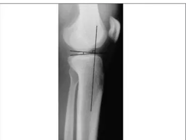 Figure 7. Box and whisker plot of tibial slope before and after surgery  (95% conidence interval).