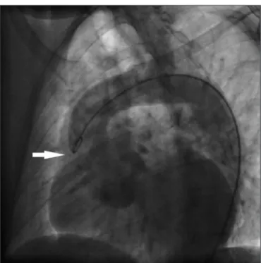 Figure 1. Aortogram showing dilated aortic root (arrow) of 5 cm in  diameter, in a 44-year-old male patient with Marfan’s syndrome.