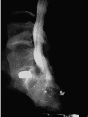 Figure 1. Lateral view of the bullet close to the spinal cord canal.