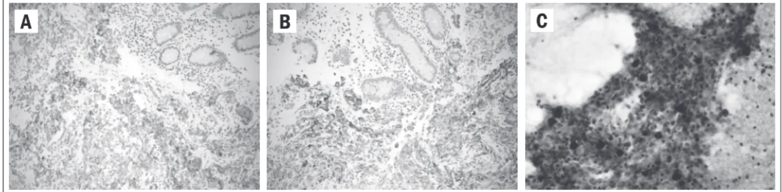 Figure 2. Computed tomography of thyroid mass. Figure 3. Abdominal X-ray. A and B: small bowel distention