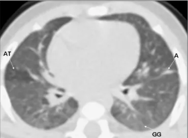 Figure 3. High-resolution computed tomography (HRCT) on a very low birth  weight premature infant, showing air trapping (AT), ground glass opacity  (GG) and septal thickening (ST)
