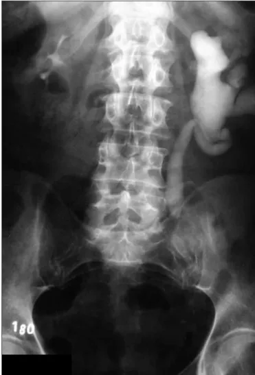 Figure 1. Intravenous urography showing moderate left 