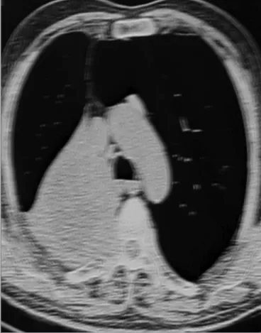 Figure 2. Chest T1-magnetic resonance imaging with gadolinium: a large  mass with heterogeneous enhancement of solid components and necrotic  non-enhancing component is seen in the right upper lobe, with destruction  of vertebrae and invasion into the spin