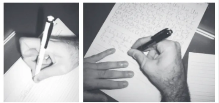 Figure 1. Dystonic posture of foreinger before the sensory-motor training  (left) and the improvement following the program (right)