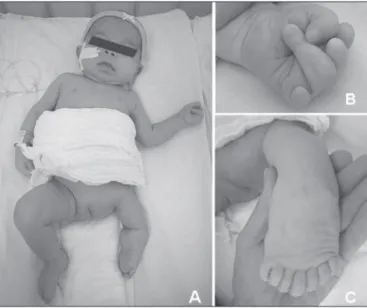 Figure 1. Patient at seven months of age showing anteverted nares,  long philtrum and hemihypoplasia (A), a left-hand reduction defect with  absence of the extremities of the second, third and ifth ingers (B) and  mirror polydactyly of the foot (C).