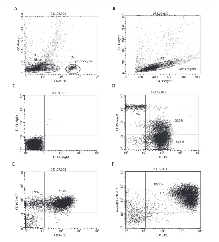 Figure 1. Immunophenotyping of B-ALL with aberrant antigen expression of CD13 in a patient at the Oncology Reference Center,  São Luís, Maranhão