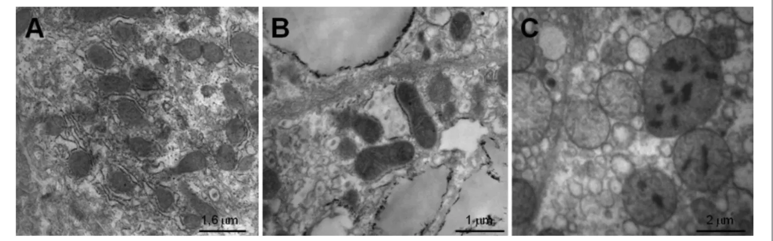 Figure 3. Mean mitochondrial surface area in the hepatocytes  from patients with steatosis compared with patients in the control  group
