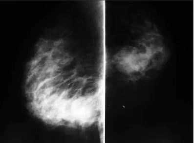 Figure 1. Radiological appearance of the lesion in the mediolateral and  craniocaudal mammographic views