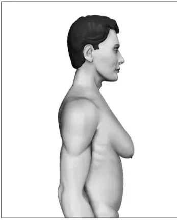 Figure 3. Grade II – Moderate hypertrophy of the breast with  the nipple-areolar complex above the inframammary fold.