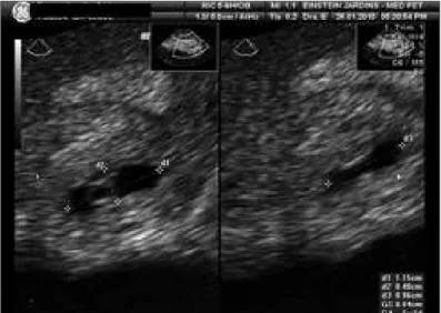 Figure 2. Embryonic cardiac activity in a case of interstitial pregnancy.
