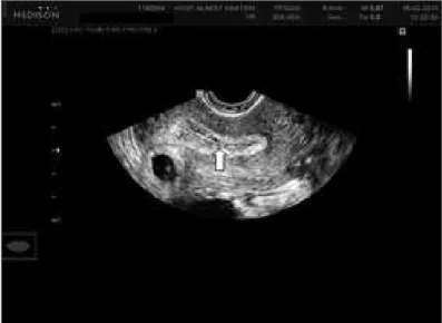 Figure 3. Gestational sac next to endometrium in a case of interstitial  pregnancy. White arrow shows the empty uterine cavity.