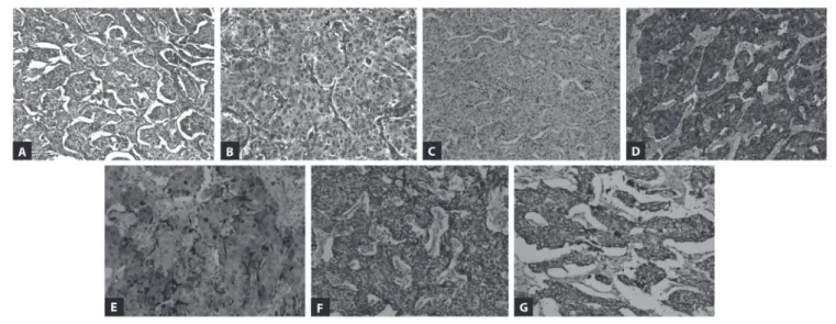 Figure 2. Paraganglioma of seminal vesicle: low-power (A); high-power (B); negative expression of CK7 (C); difuse positive expression of  chromogranin (D); positive expression of S100 in sustentacular cells (E); and positive expression of SDHA (F) and SDHB
