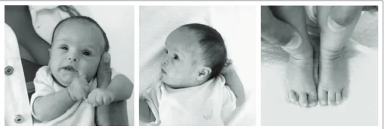 Figure 1. The patient at the age of three months. (A) Face, (B) proile, (C) feet (note the overlapping toes).