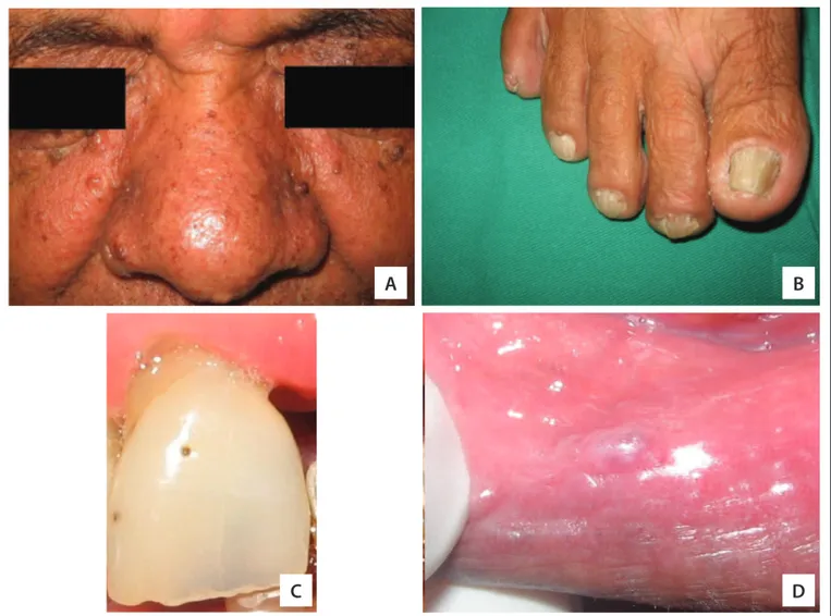 Figure 1. Clinical features identii ed in the patient aﬀ ected by tuberous sclerosis complex
