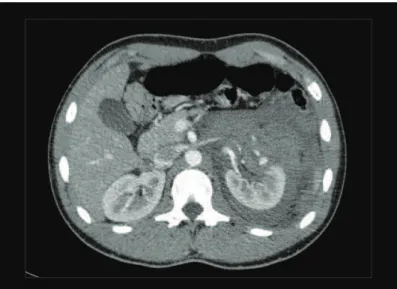 Figure 2. Angiographic conirmation of renal artery  pseudoaneurysm (A) in Case 1 and result after embolization  using microcoils (B).