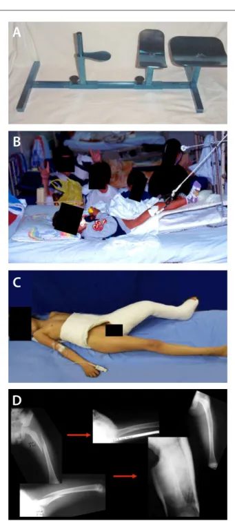 Figure 1. Children’s orthopedic table (A) for traction (B)  and cast (C), for children with femoral shaft fractures; and  radiographs showing the reduction control before and after  the cast was applied (D).