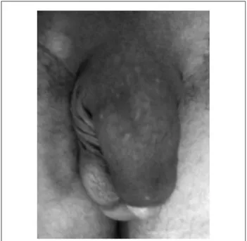 Figure 1. Penis appearance after methacrylate injection.