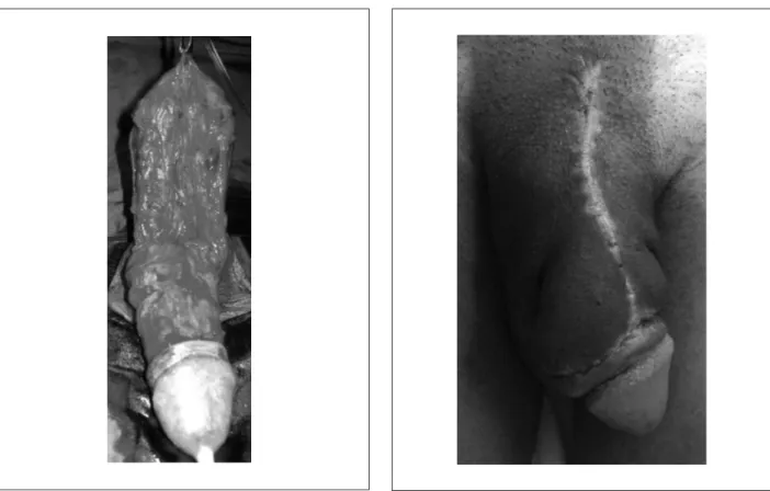Figure 5. Penis appearance two months after surgery. 