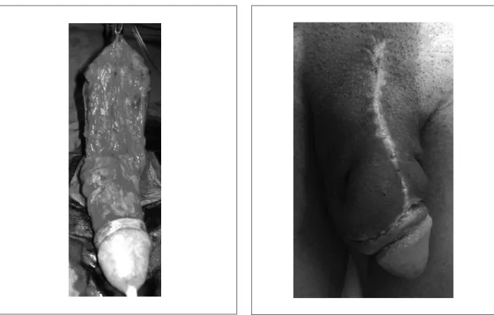 Figure 5. Penis appearance two months after surgery. 