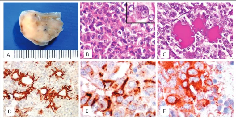 Figure 2. Polyp-like specimen excised from left nasal cavity. External surface was smooth and shiny, cut surface solid and irm, and  translucent in some areas (A)