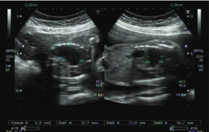 Figure 2. Fetal magnetic resonance imaging showing indings  compatible with left-side diaphragmatic hernia (see arrows).