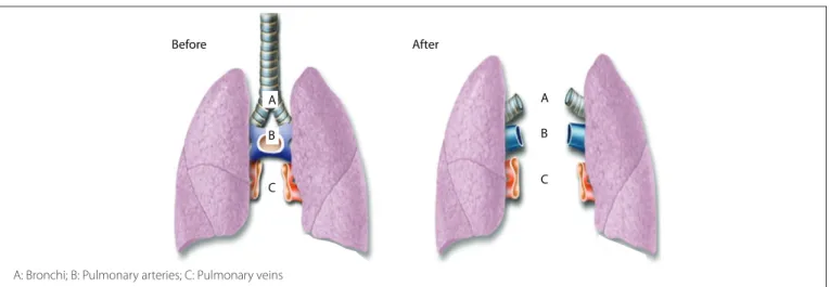 Figure 1. Preparation of the double-lung block before (left) and after (right) separation of the grafts