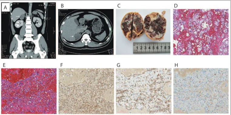 Figure 1. A case of cavernous hemangioma of the adrenal gland. A, B: Computed tomography scan (right adrenal mass, arrows)