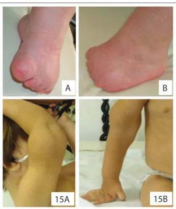 Figure 5. Details of the patients presenting atypical  i ndings. Note lower-limb reduction defect (patient 5) and  tumor in the distal portion of the right arm, suggestive of a  hemangioma/lymphangioma (patient 15) (permission was  obtained from the patien
