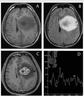 Figure 1. Magnetic resonance imaging (MRI) of brain on  admission, showing: hypointense image with T1 weighting (A); 
