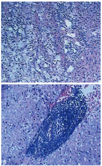 Figure 2. Pathological examination showing that the  lesion consisted of dense accumulation of macrophages,  lymphocytes and reactive astrocyte (A-B).