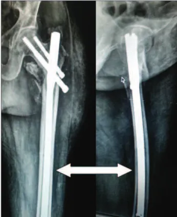 Figure 3. Postoperative radiographs produced after revision  surgery, showing that the broken guidewire was removed  and a long femoral nail was inserted (white arrow).